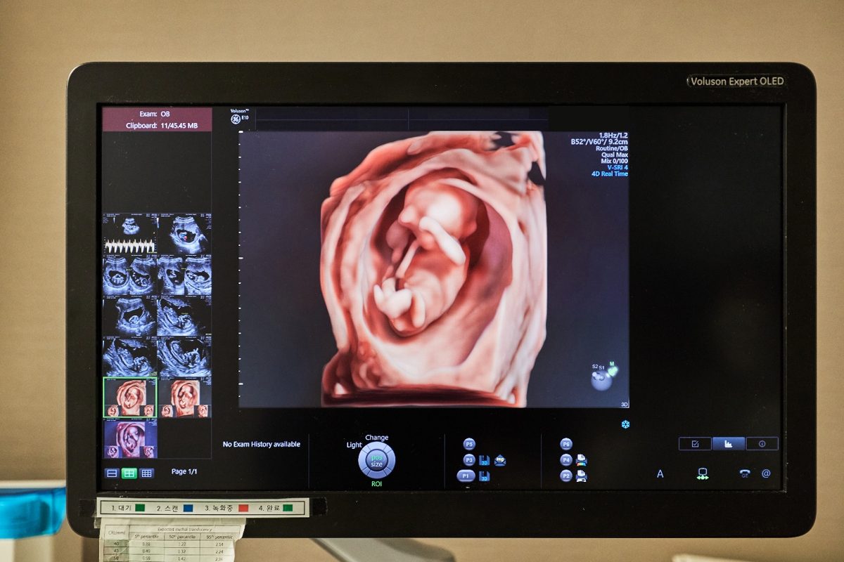 A 3D prenatal ultrasound image on a monitor